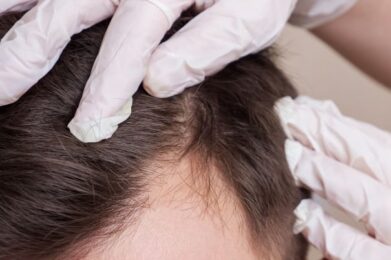 amir-medecine-esthetique-com-blog-greffe-de-cheveux-processus